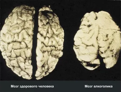 Сравнение анатомии мозга в состоянии алкогольного опьянения и трезвости