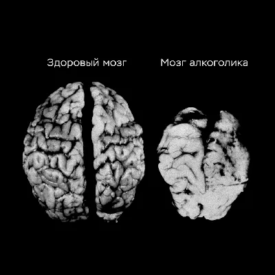 Эффект алкоголя на мозг: наглядные сравнительные изображения