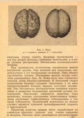 Изучение морфологии мозга через объектив фотокамеры: алкоголь vs. трезвость