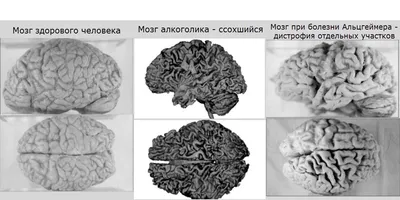 Фотографии мозга при употреблении алкоголя и воздержании от него