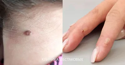 Фотка наростов на голове: Скачать изображение в JPG