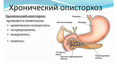 Описторхоз у человека  фото