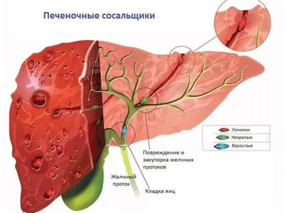 Фотогалерея Описторхоза: Размеры и Форматы по вашему вкусу