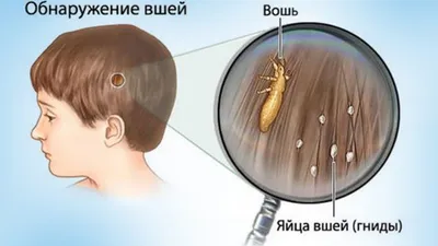 Паразиты на голове человека фотографии