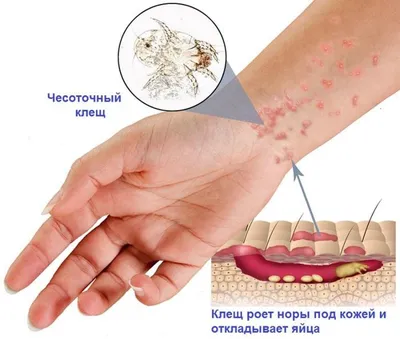 Паразиты под кожей человека: скачивайте в JPG, PNG, WebP