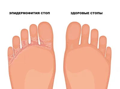 Формат по вашему выбору: Парша у человека в JPG, PNG, WebP изображениях