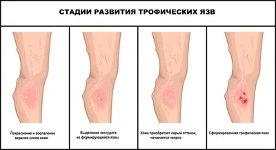 31. Изображения подкожных червей: Фотографии с высоким разрешением