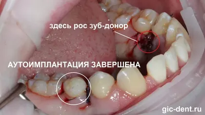 Полиодонтия человека: выбор размера и формата для скачивания фото