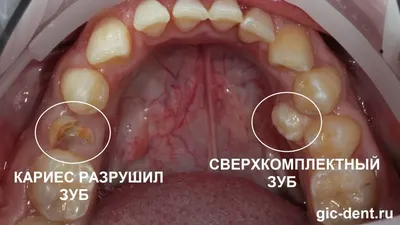 Полиодонтия у человека: фото в различных форматах и скачиваемых размерах