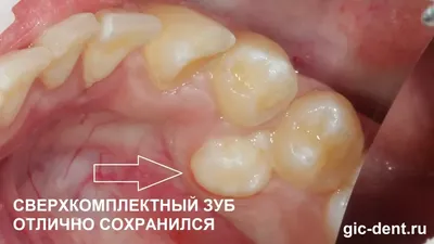 Изображение полиодонтии у человека: настройка размера и формата скачивания