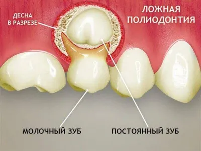 Фото с полиодонтией у человека: опции загрузки и форматы