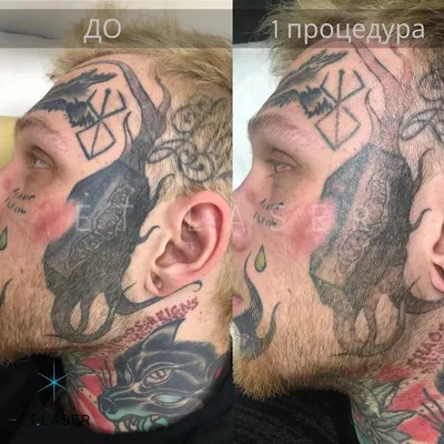 Фотографии после удаления татуировки: форматы и размеры для скачивания