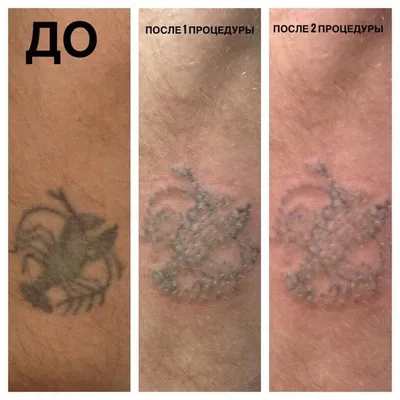 Фотки после удаления татуировок: выберите формат и размер изображения