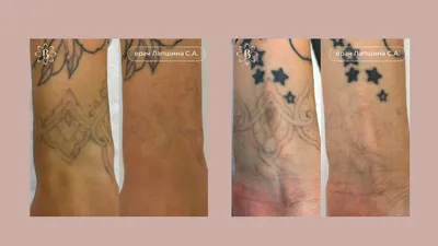 После удаления тату: фотографии с разными размерами и форматами