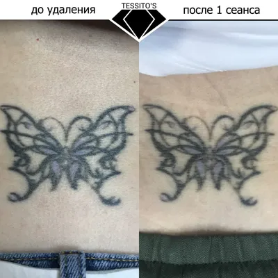 Фото после удаления татуировок: доступные форматы и размеры файлов