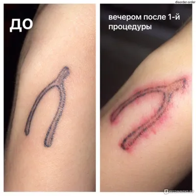 Удаление тату: фото скачиваемых изображений в разных форматах