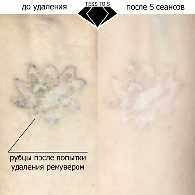 Удаление татуировок: фотографии для скачивания в разных форматах