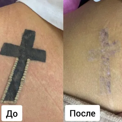 [43+] После выведения тату фото
