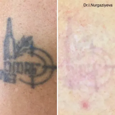 Фото история после удаления татуировки