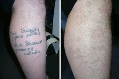 Татуировка до и после: изображение