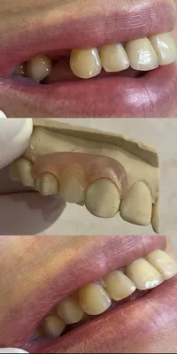 Изображение протеза бабочки на зубах для загрузки в WebP