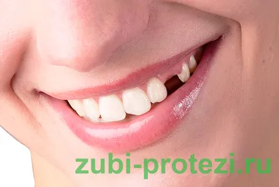 Картинка протеза бабочки на зубах - формат JPG, WebP