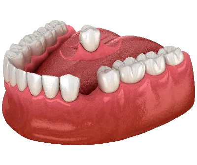 Фотка протеза бабочки на зубах с возможностью выбора размера и формата