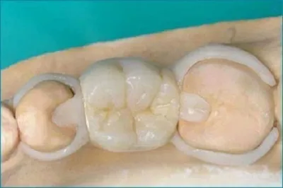 Картинка протеза бабочки на зубах - оптимальный размер JPG