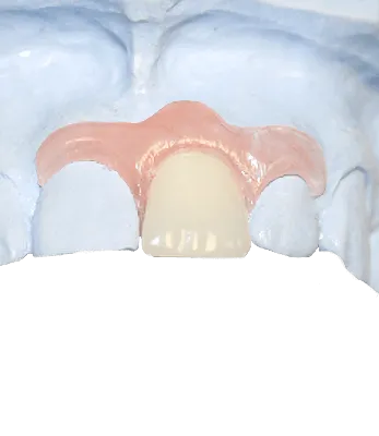 Фотка протеза бабочки на зубах в формате PNG