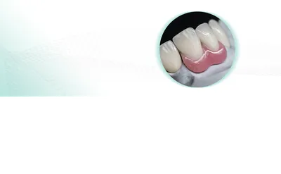 Картинка протеза бабочки на зубах - формат JPG, WebP