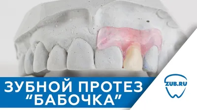 Изображение протеза бабочки на зубах для скачивания в JPG