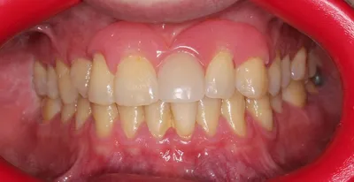 Фотка протеза бабочки на зубах в формате PNG, WebP