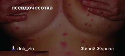 Псевдочесотка у человека: Изумительные фотографии в высоком разрешении