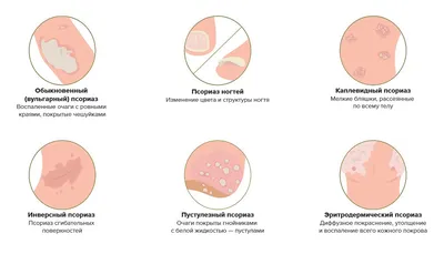 Человек с псориазом: Фотография в высоком качестве