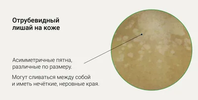 Изображения разноцветного лишая: симптомы и лечение