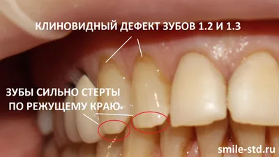 Самая красивая форма зубов фотографии