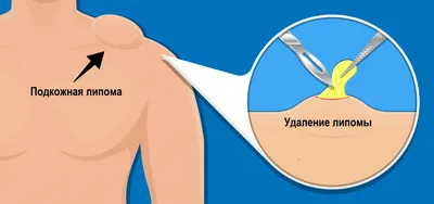 34. Изображения Шишек на теле: выбирайте формат и размер