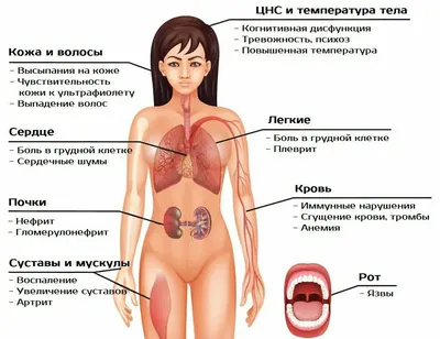 HD изображения Системной красной волчанки для скачивания