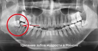 Фотографии разновидностей зубов человека: выбор формата и размера