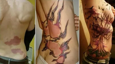 18) Фотография тату после успешной абдоминопластической процедуры
