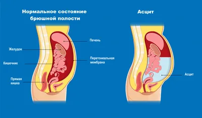 Эмоциональное изображение цирроза печени: JPG, PNG, WebP – на ваш выбор