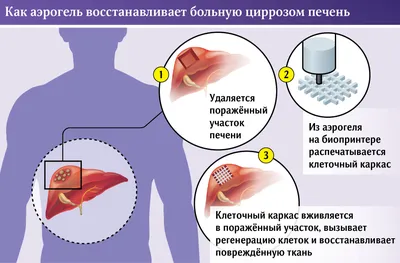 Изображение цирроза печени: Фото, картинка, скачать в формате PNG