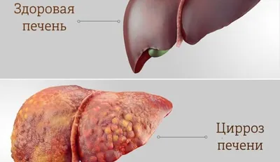 Фото человеческого цирроза печени: Скачайте изображение в WebP формате