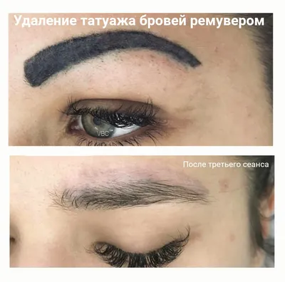 Наслаждайтесь качественными изображениями: фотографии удаления тату