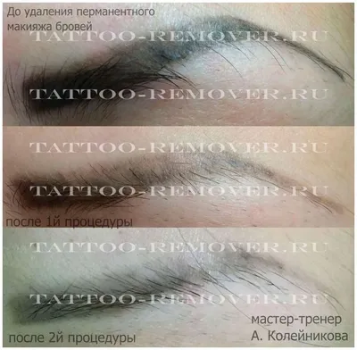 Фотка удаления тату с помощью ремувера: выберите подходящий формат