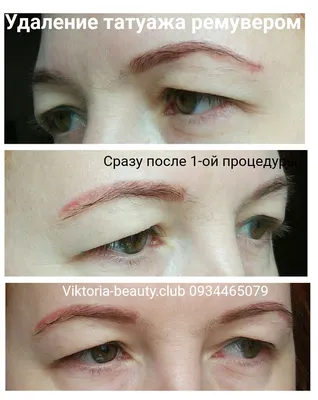 Фото удаления тату ремувером: выберите размер изображения