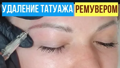 Избавление от тату в домашних условиях: фото с результатами