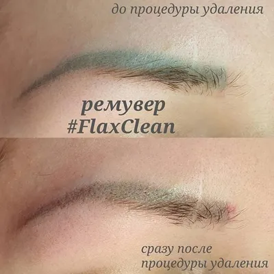 Удаление тату ремувером: скачайте качественную фотографию