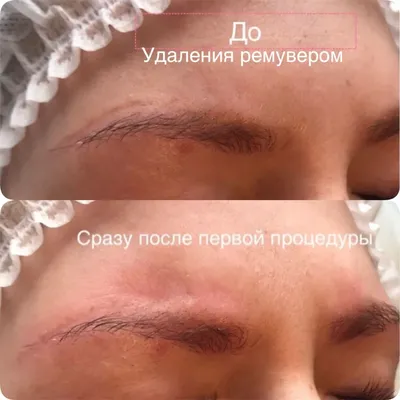 Преобразование вашей кожи: удаление тату на изображении