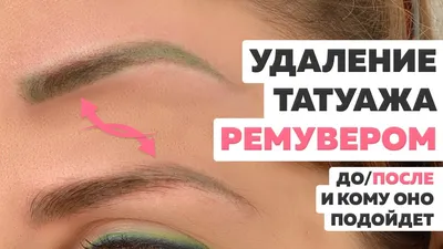 Безболезненное удаление тату: скачайте изображение в webp формате